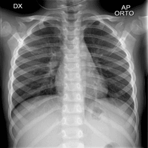 COVID-19 X-Ray Diagnosis